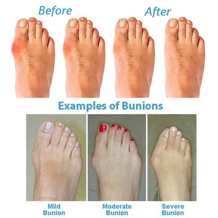 Dam Hallux Valgus Rättande Sandaler | Ortopediska Bred Tåbox
